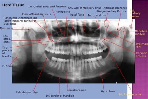 Anatomical Landmarks On Panoramic Radiography Dentstudy Co