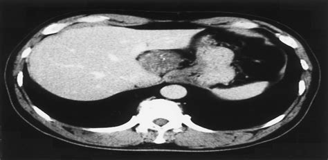 Laparoscopic Resection Of A Retroperitoneal Schwannoma Behin