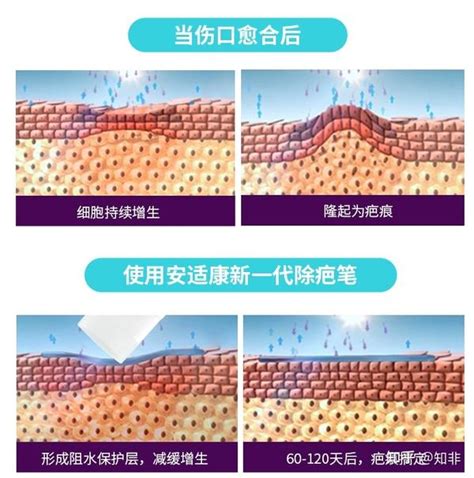 疤痕治疗选择指南 市面上常见的祛疤产品有哪些 知乎