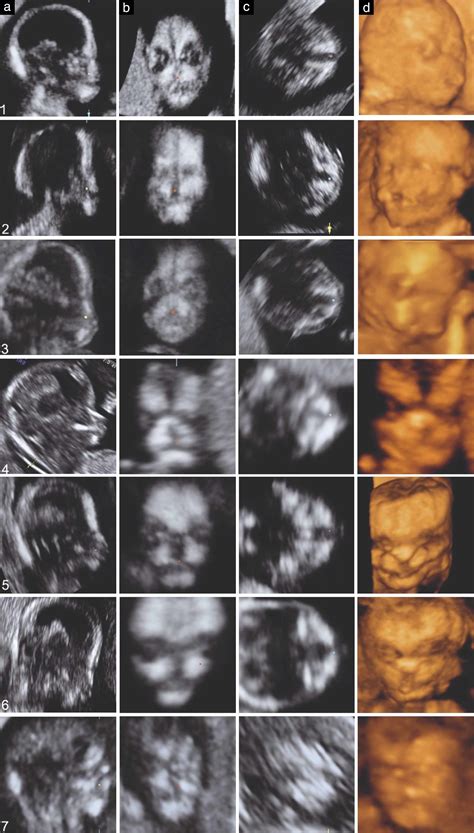 Lip Anatomy Ultrasound At Jennifer Shields Blog