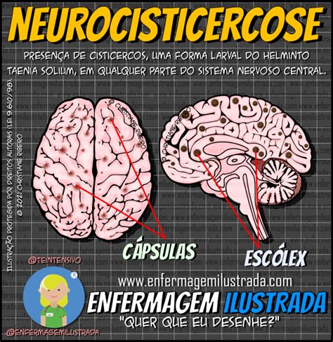 Neurocisticercose O Que É