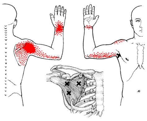 Puntos Gatillo Que Afectan El Músculo Subescapular El Paso Back