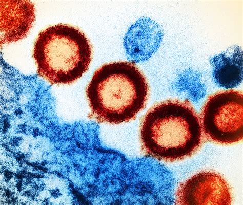 Early Hiv Diagnosis And Treatment Important For Better Long Term Health