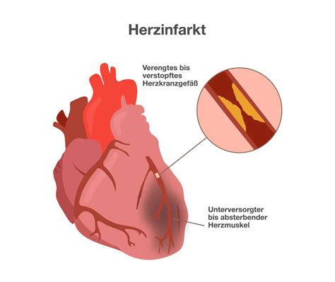 Herzinfarkt Gefäßverschluss Im Herz