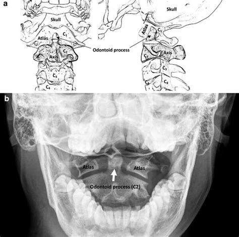 Atlanto Axial Joint Wikism Sports Medicine Wiki