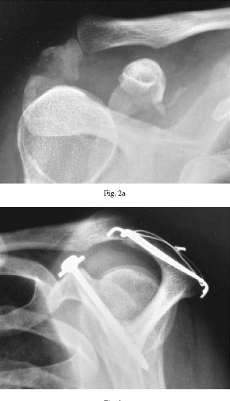 Figure 2 From Fractures Of The Coracoid Process Semantic Scholar