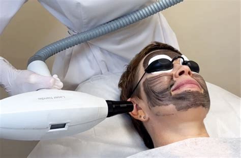 Карбоновый пилинг лица лазером Q-Switch Capello, цена в клинике в СПб