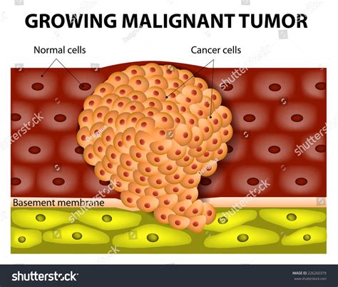 Cancer Cells Growing Malignant Tumor Malignant Stock Illustration 226260379 