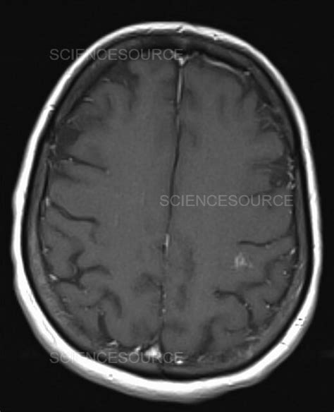 Photograph Subacute Infarct Mri Science Source Images