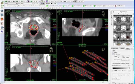 Oncentra Brachytherapy Planning System Medical Dosimetry