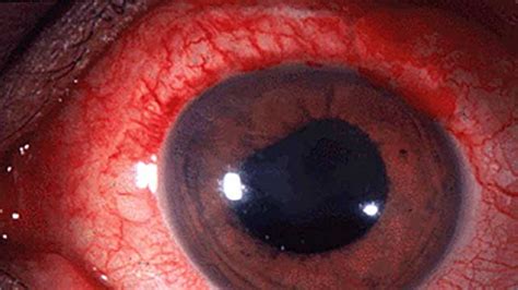 Acute Uveitis