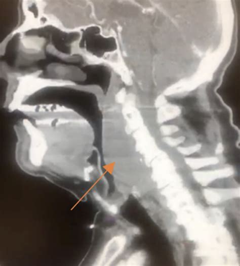 Retropharyngeal Abscess — Emergency Medicine Board Review