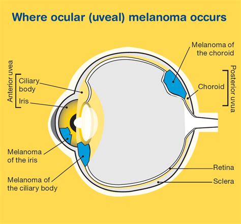Ocular Melanoma