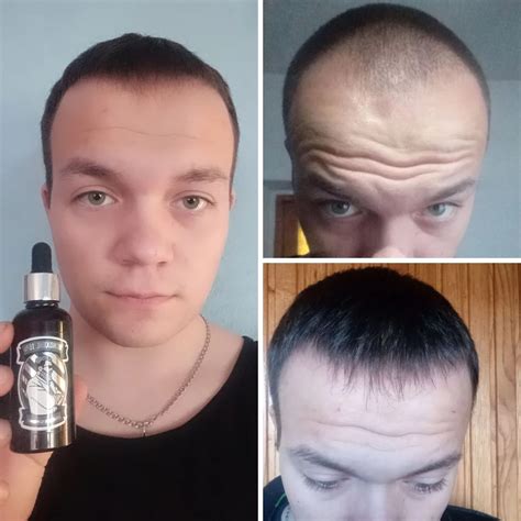 ᐈ Лосьон для роста волос и бороды Minox Hair Growth Lotion Minoxidil 15 ...