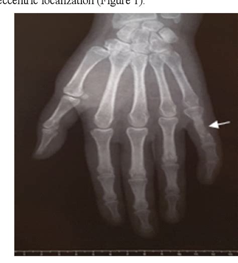 Table 1 From Hand Enchondroma Complete Evaluation And Rehabilitation