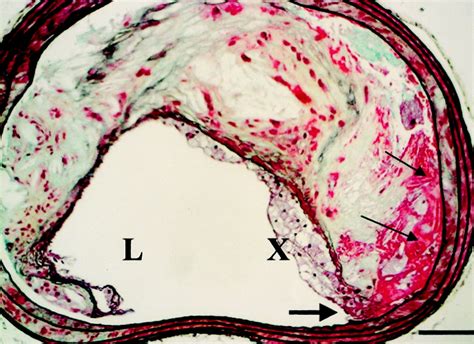 Advanced Atherosclerotic Lesions In The Innominate Artery Of The Apoe