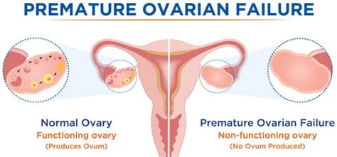 Unravelling The Mystery Behind Premature Ovarian Failure Bridge Clinic