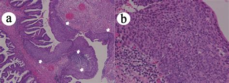 CIN3, coexisted with adenocarcinoma. (a) CIN3 lesion (indicated by... | Download Scientific Diagram