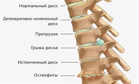 Остеохондроз 1 степени: поясничного, грудного, шейного отделов позвоночника