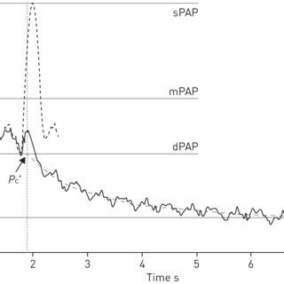 Pulmonary Artery Waveform Analysis