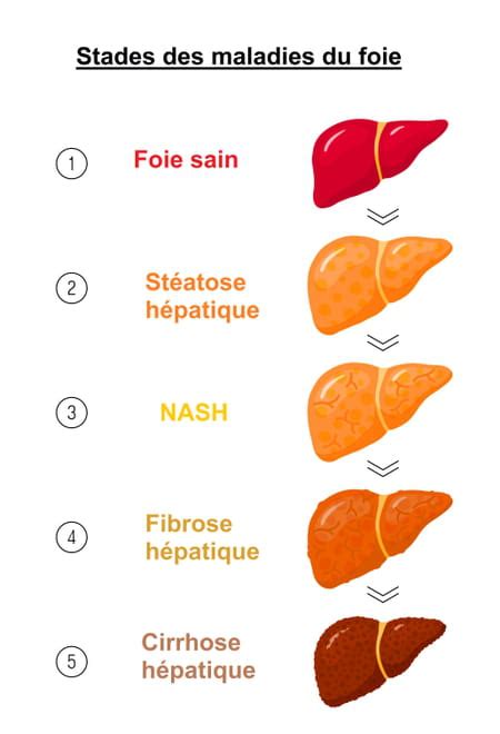 Nash Symptôme Cest Quoi La Maladie Du Foie Gras