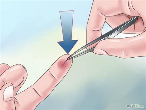 Healthcare Times How To Remove A Splinter