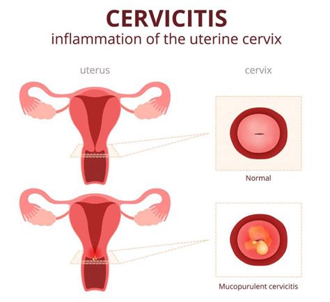 Cervicita Simptome Si Tratament