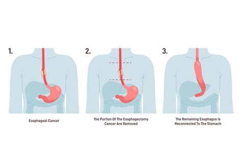 Esophagectomy O2 Healthcare Group