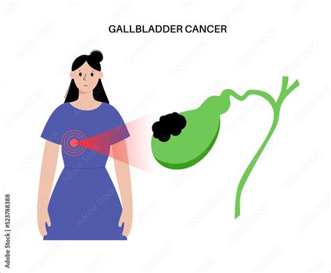 Gallbladder Cancer Anatomy Stock Vector Adobe Stock