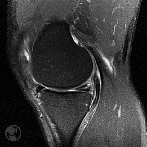 ¿conoces Las Lesiones Meniscales De Rodilla Y Su Clasificación Aware