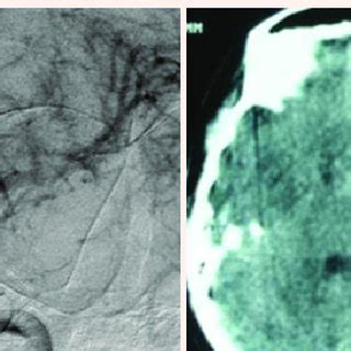 Left giant supraclinoid aneurysm ruptured. | Download Scientific Diagram