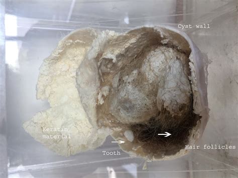 Dermoid Cyst Of Ovary Gross Histopathology Guru