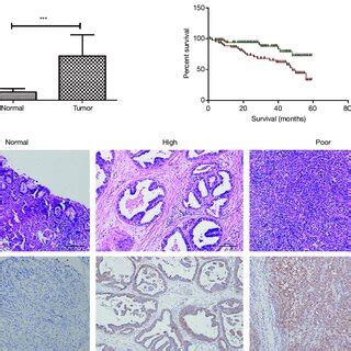 Rab Predicts Poor Prognosis In Gastric Adenocarcinoma A Comparison