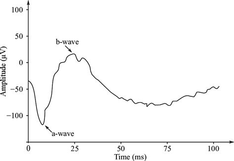biphasic waveform   healthy patient  negative wave