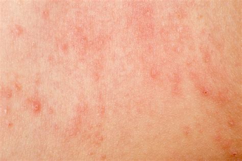 Chronic Idiopathic Urticaria: Treatment with Omalizumab (Family Practice)