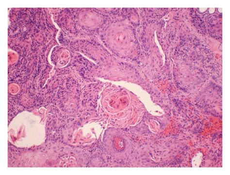 Showing Well Differentiated Squamous Cell Carcinoma Characterized By