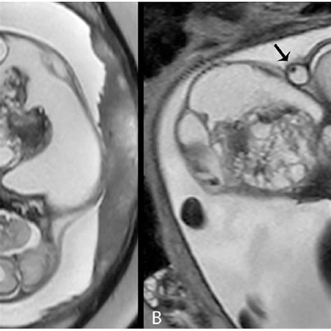 A Axial And B Sagittal T2 Haste Images From A Prenatal Mri Download Scientific Diagram