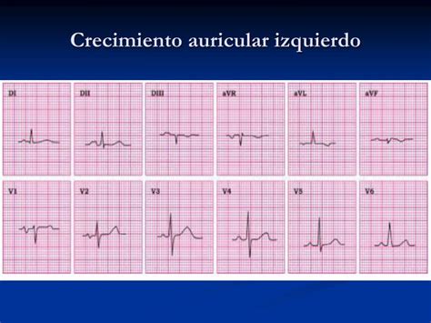 Ppt Crecimiento Auricular Y Ventricular Powerpoint Presentation Id