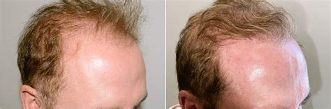 Body Hair Transplant Hair Transplants For Men Reparative Hair Transplant Photos Miami Fl