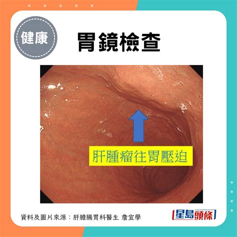 大腸癌症狀｜女子常覺噁心胃口差 求醫揭患大腸癌 醫生揭原因教分辨症狀 星島日報