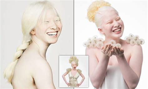 Famous People With Albinism