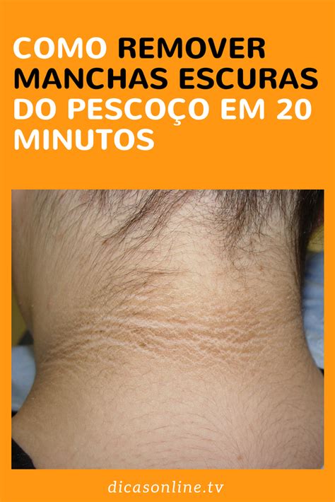 Como Clarear O Pescoço - Receitas naturais para remover manchas escuras e clarear pescoço e ...