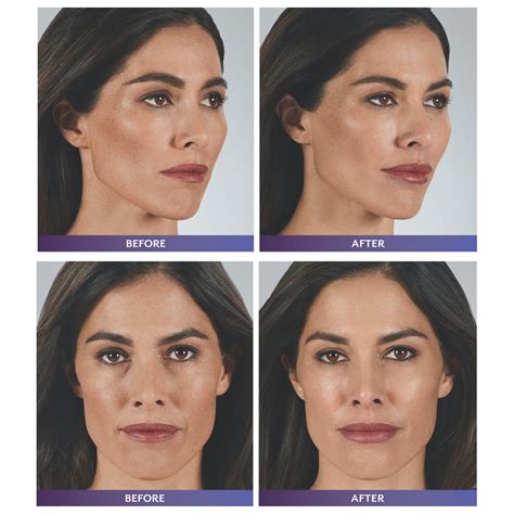 Facial Filler Before And After Feel Ideal Med Spa Southlake Tx