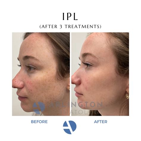 Ipl Laser Resurfacing Near Me Arlington Va Dc Mclean