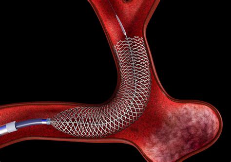 Flow Diverter In Aneurysm Cgtrader