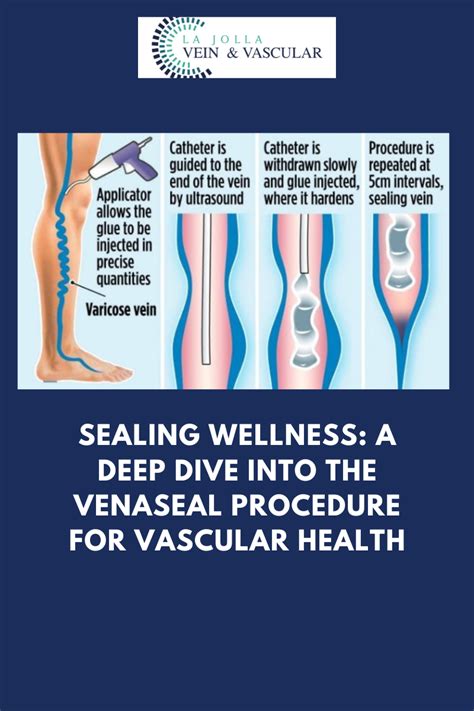 VenaSeal Procedure for Vascular Health | VenaSeal Treatment