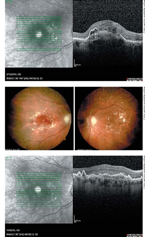 Figure 1 From Anatomical And Functional Outcome Of Pars Plana