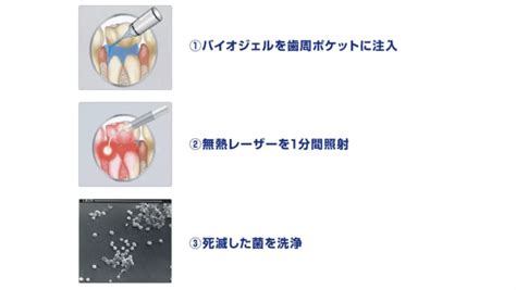 高效无痛治疗牙周炎 日本最新光动力抗菌疗法 搜狐大视野 搜狐新闻