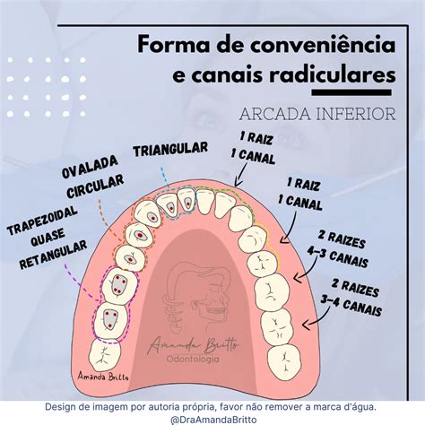 Endodontia Forma De Conveniência E Canais Radiculares Arcada Inferior