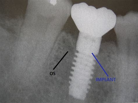 Diferenta Dintre Un Pivot Si Un Implant Dentaroral Dent